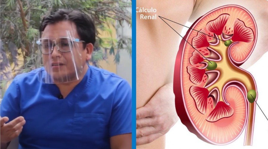 Dr. Angel Gonzales Viera nos explica que ayuda a formar los cálculos renales